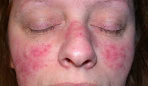 Acne and Rosacea Treatment - clear skin after therapy