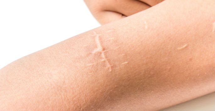 Scar revision procedure