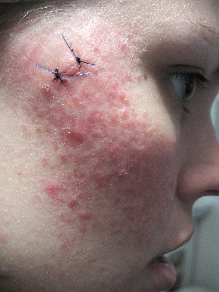 Skin biopsy procedure