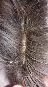 Close-up of dandruff flakes on scalp