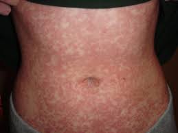 Illustration of a drug-induced skin rash