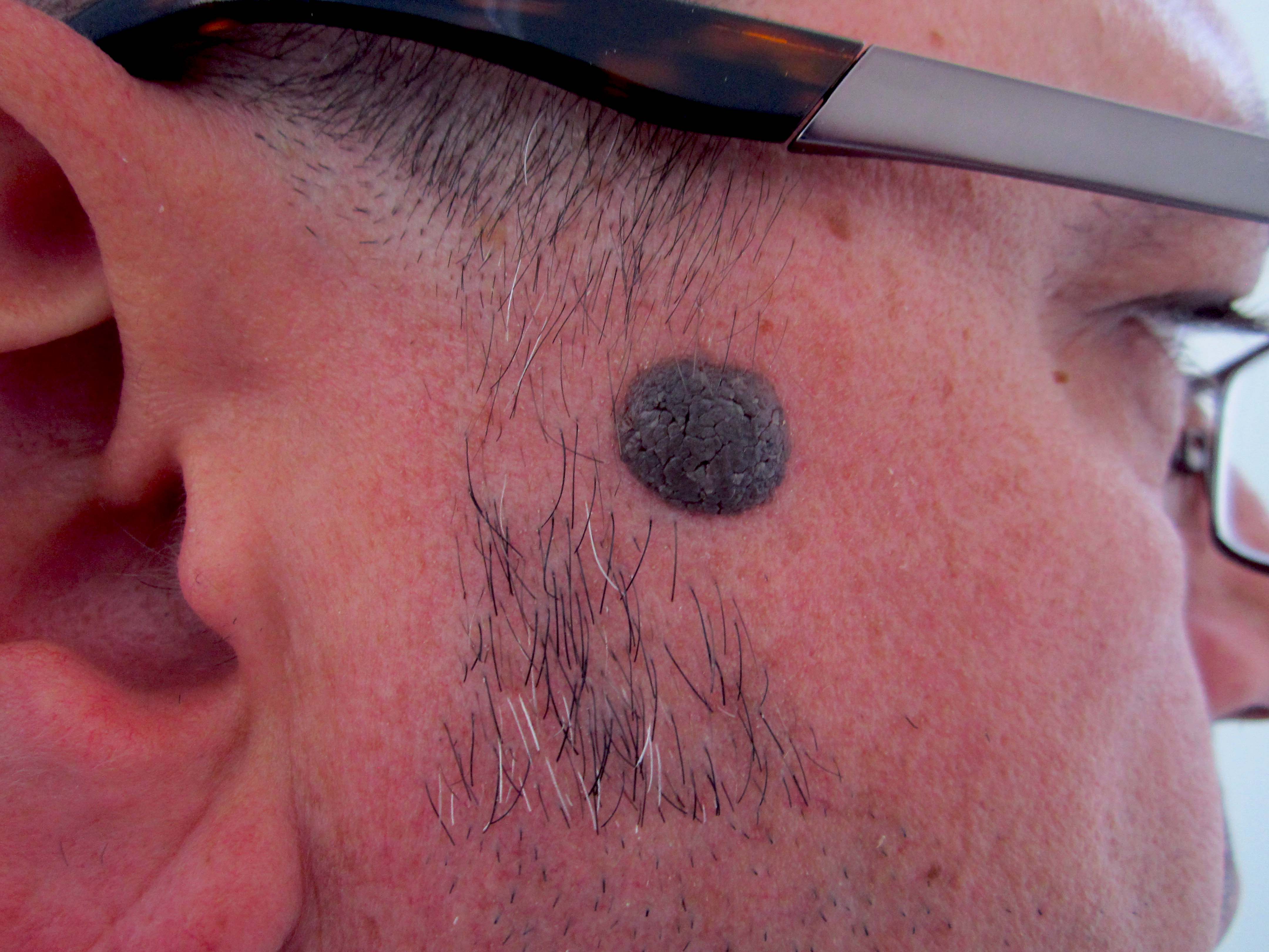 Wart, Mole, and Skin Tag treatment